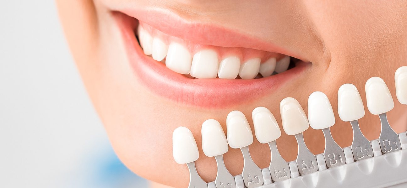 Dental Veneers