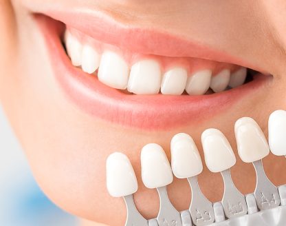 What Is the Process for Getting Dental Veneers? 