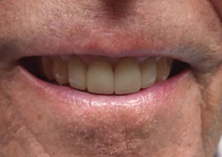 ME's Care : Dental Crowns
