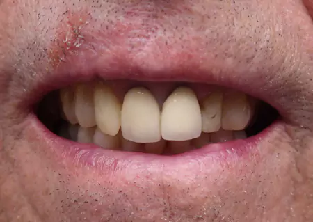 ME's Care : Dental Crowns