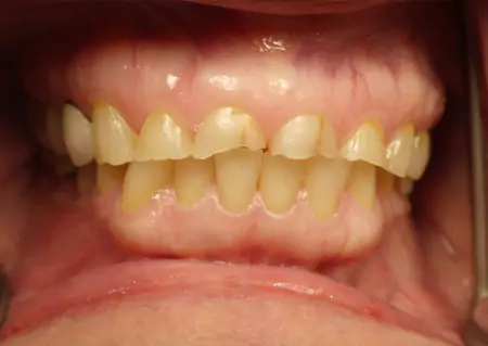 TH's Case: Full Mouth Reconstruction
