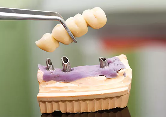 Dental Bridge