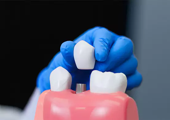 Dental Implants