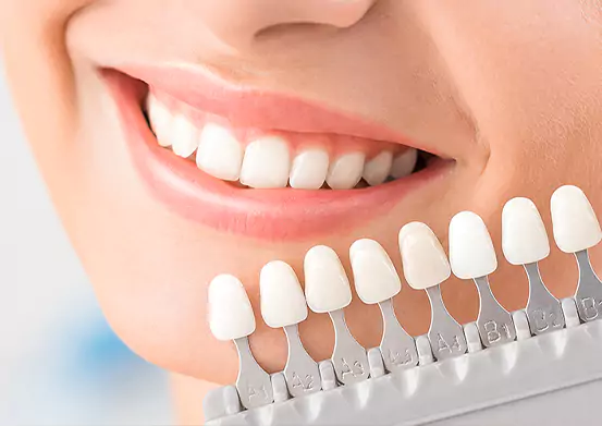 Dental Veneers