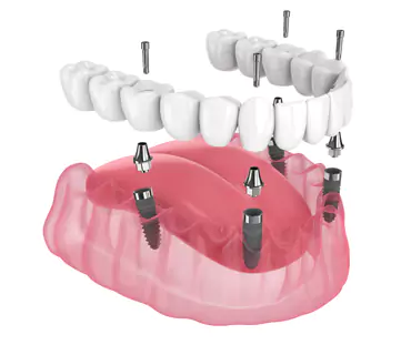 ALL ON 4 DENTAL IMPLANT CONSULTATION