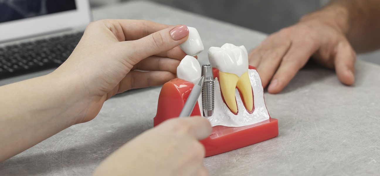 The Benefits of Dental Implants and Why They’re Worth the Investment