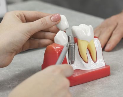 The Benefits of Dental Implants and Why They’re Worth the Investment 