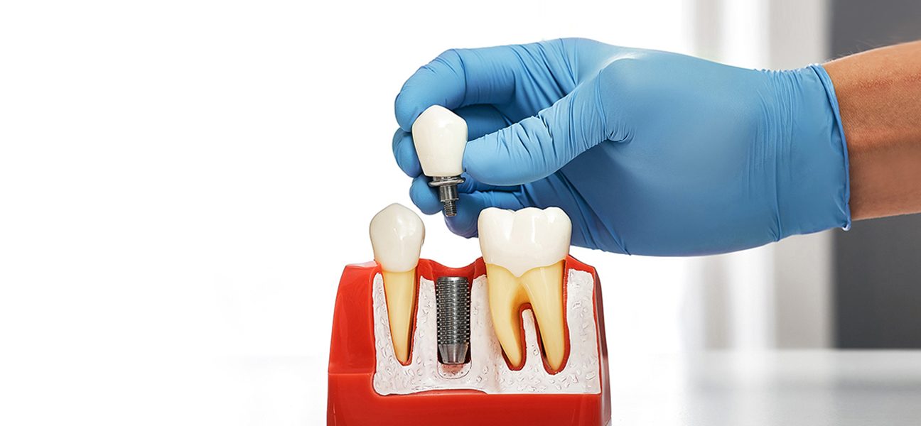 What Are Dental Implants? A Comprehensive Guide