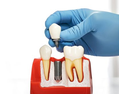 What Are Dental Implants? A Comprehensive Guide 