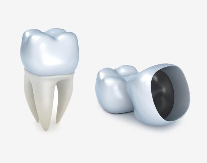 How Dental Crowns Can Improve Your Smile in Just One Visit at Eureka Ridge Dentistry? 